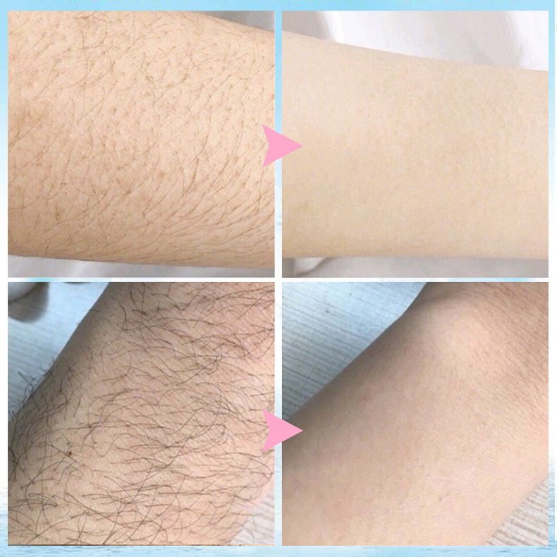 🔥 Magic Hair Removal & Hair Inhibitor【Buy 5+ Get Extra 25% OFF】